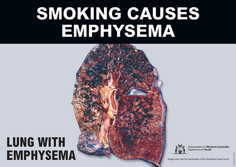 Banner: smoking causes emphysema