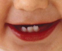 Baby smiling , showing three baby teeth