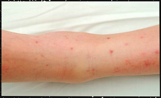 Example of a skin rash from mosquito-borne diseases such as Ross River virus and Barmah Forest virus